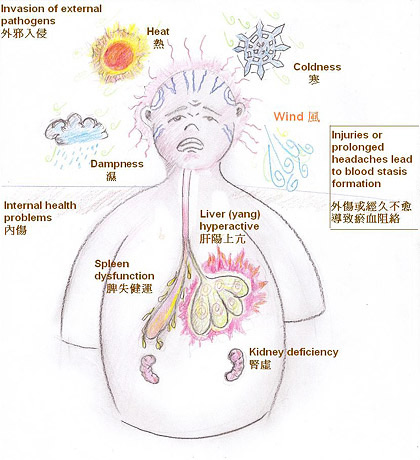 中醫看頭痛病機