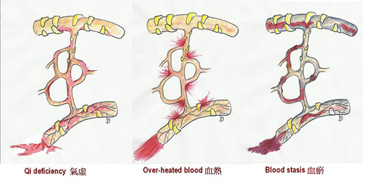 TCM views on the development of bleeding