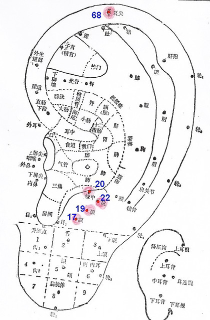 The auricular points for headaches