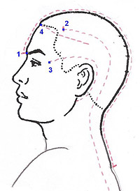 Needle tapping route chart for headaches