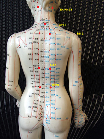 1. Cupping locations for hypertension